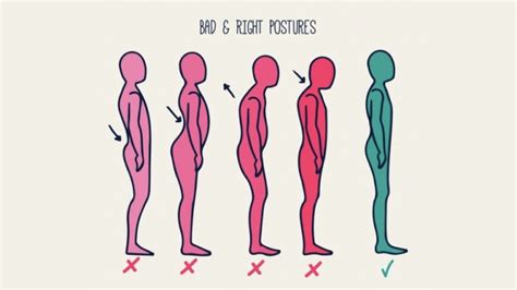 Physiotherapy Exercises To Correct Bad Posture