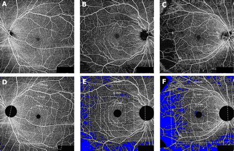 Representative Swept Source Optical Coherence Tomography Angiography