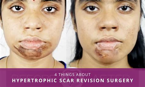 Hypertrophic Scar Before And After