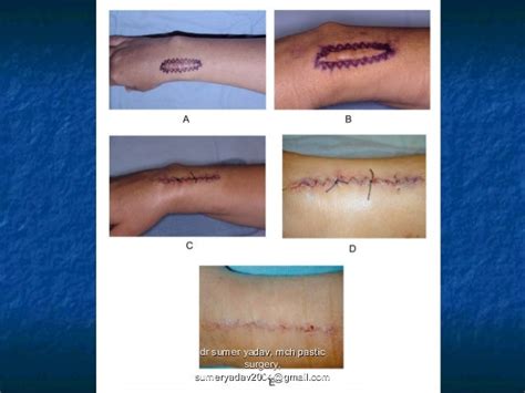 scar revision , z plasty