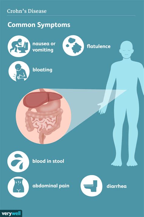 Symptomen Van De Ziekte Van Crohn Med NL