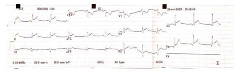 A Ekg Showing Normal Sinus Rhythm With St Elevations In Leads Download Scientific Diagram