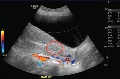 Transvaginal Ultrasound Of The Uterus Download Scientific Diagram Images