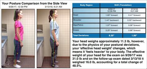 Forward Head Posture Before And After