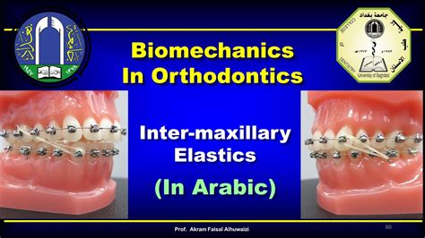 Intermaxillary Elastics In Orthodontics In Arabic Youtube