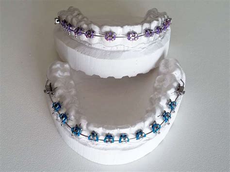 Clear Retainer with Brackets | Fake Braces | Special Appliances ...