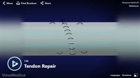 Video: Tendon Repair - Hughston Clinic