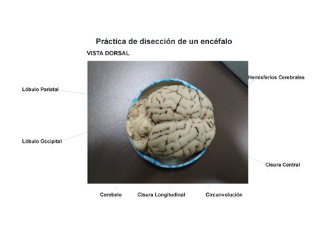 Práctica De Disección De Un Encéfalo Práctica De Disección De Un Encéfalo Vista Dorsal