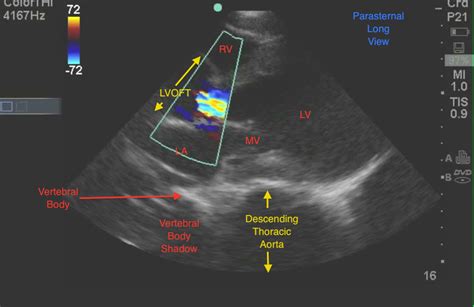 Emory Emergency Ultrasound Aortic Dissection With Acute Aortic Regurgitation