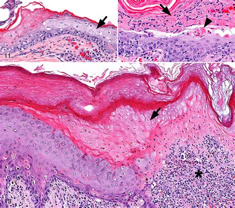 Toxic Epidermal Necrolysis Dog