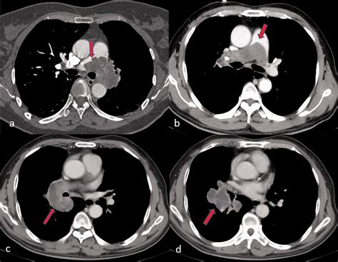 The Filling Defect Of Pulmonary Artery An Imaging Finding What We