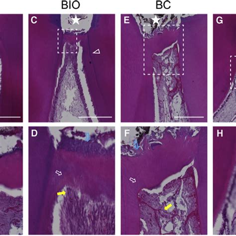 sequential steps  pulpotomy   portland cement