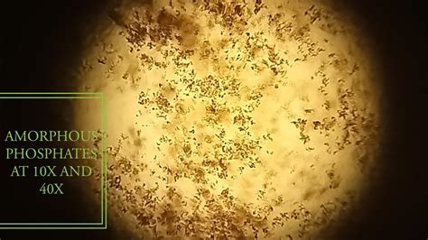 Amorphous Phosphate In Urine