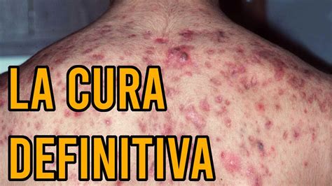 Acne Come Eliminare I Brufoli Anche Continuando A Prendere Steroidi