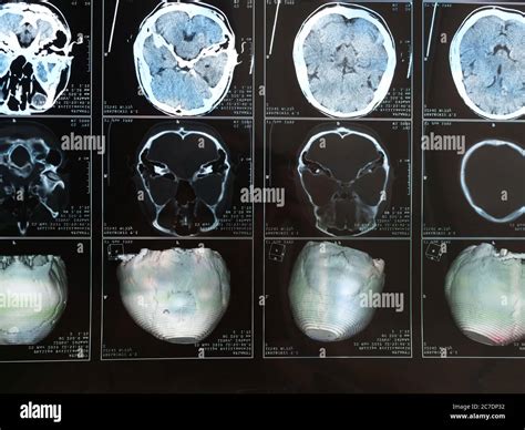 Esta Foto Muestra Una Resonancia Magnética Del Cerebro Después De Una