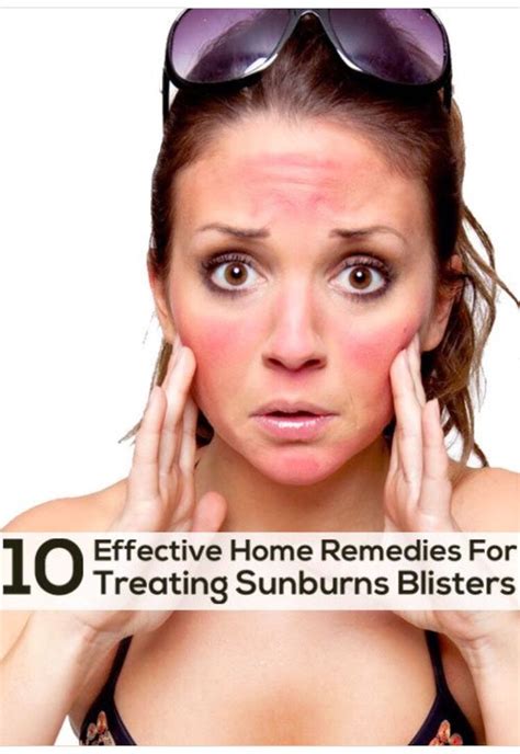 10 Effective Home Remedies For Treating Sunburn 😱🌝🌞 Home Remedies