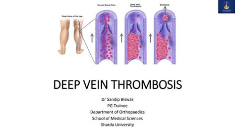 Deep Vein Thrombosis Ppt