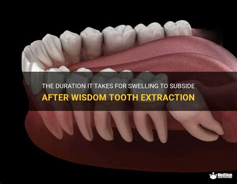 The Duration It Takes For Swelling To Subside After Wisdom Tooth