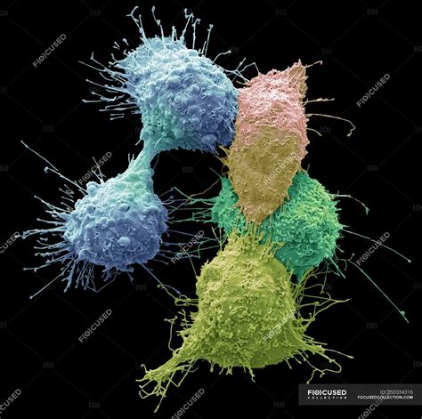 Coloured Scanning Electron Micrograph Of Ovarian Cancer Cells — Microbiology Growth Stock