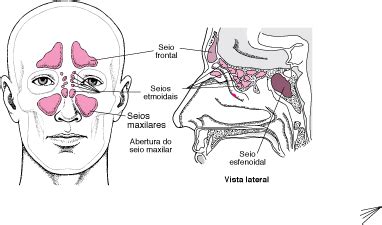 Sinusite Ataca O Ouvido - Sinusite - Distúrbios do ouvido, nariz e garganta - Manual MSD Versão ...