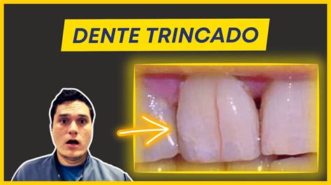 DENTE RACHADO OU TRINCADO O QUE FAZER YouTube