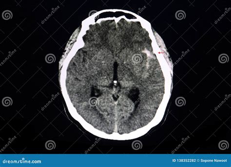 CT brain ruptured aneurysm stock photo. Image of diagnosis - 138352282