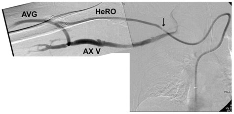 Hero Catheter Placement