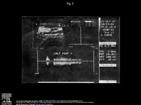 Quantification Of Venous Reflux By Means Of Duplex Scanning Ppt Download