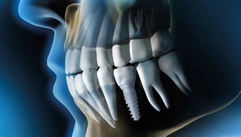 Zirconia Dental Implants Las Vegas, NV - Four Seasons Dental Spa