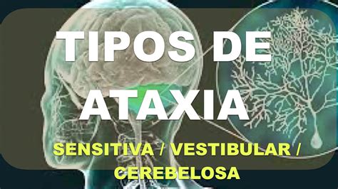 Ataxia Diagn Stico Diferencial Vestibular Sensitivo Cerebeloso