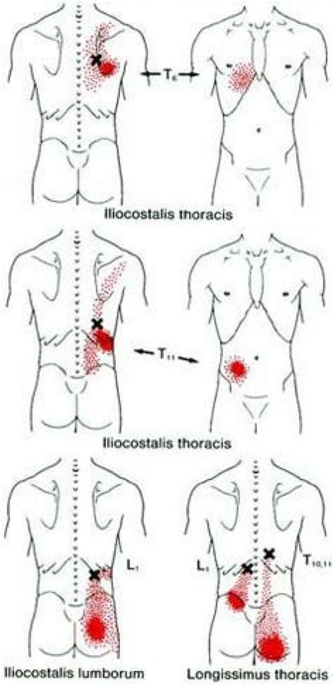 Trigger Point Maps Psoasexercises In 2020 Massage Trigger Points Trigger Point Therapy