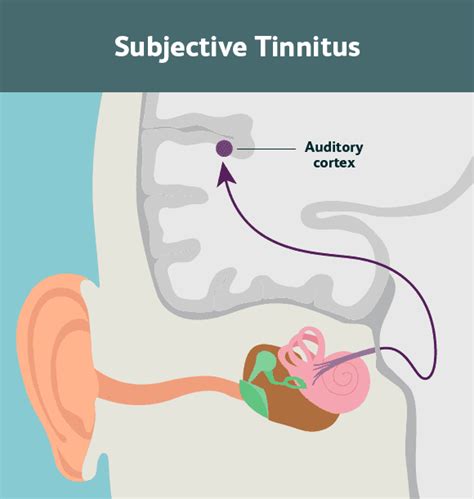 Different Types of Tinnitus - Earsolutions