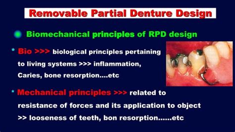 2 B Basic Principles For Designing Kennedy Class Ii Iii And Iv Removable Partial Denturerpd