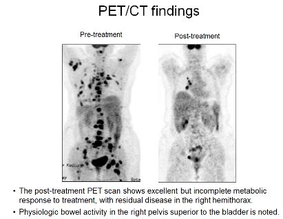 Pet scan, Pet ct, Nuclear medicine