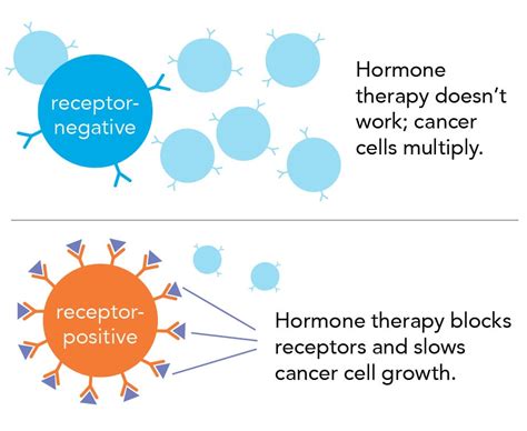 Breast Cancer Diagnosis Staging Surgery And Treatment Options