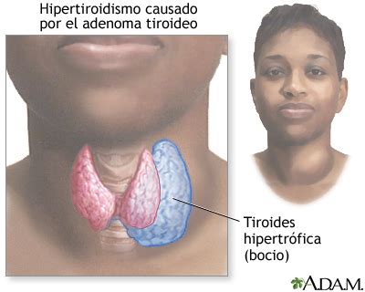 Hipertiroidismo Medlineplus Enciclopedia M Dica 27072 The Best Porn