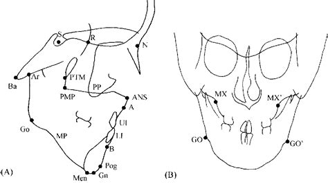 Figure From Comparison Of Craniofacial Morphology In Patients With