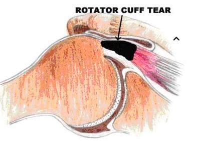 Rotator Cuff Tear Repair