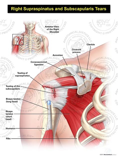 Bicep Tendon Tear | lupon.gov.ph