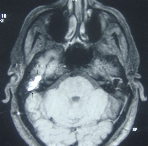 Cholesterol Granuloma Presenting As A Mass Obstructing The External Ear