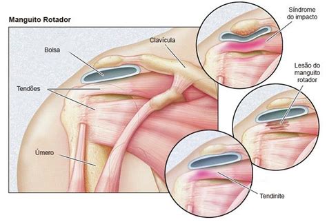 Síndrome Do Impacto No Ombro Clínica Conex em Ijuí RS
