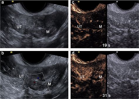 Differentiating Benign From Malignant Ovarian Masses With Solid