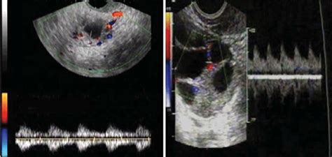 Ovarian Artery Flow In A Early Proliferative Phase B Periovulatory