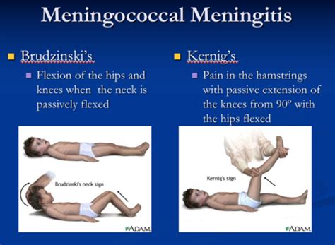 Meningitis Flashcards Quizlet