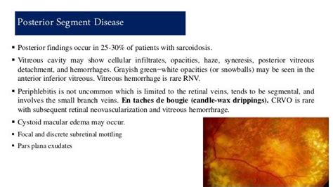 Ocular sarcoidosis