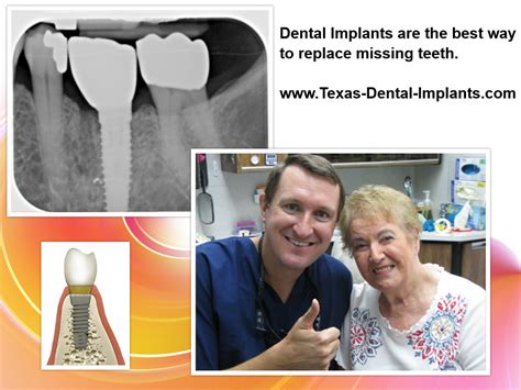 Dental Implants Pasadena Texas Dr Nugent