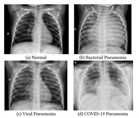 Chest X Ray Bronchitis Vs Pneumonia