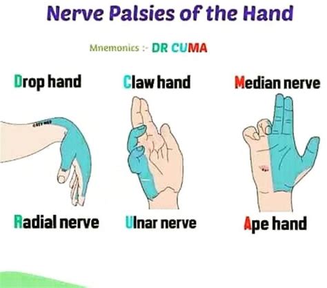 Ulnar Nerve Injury Claw Hand