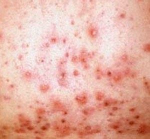 Free For Health: Severe Cystic Acne