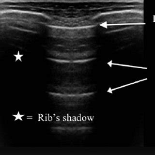 Midaxillary line from the axilla to the diaphragm. | Download ...